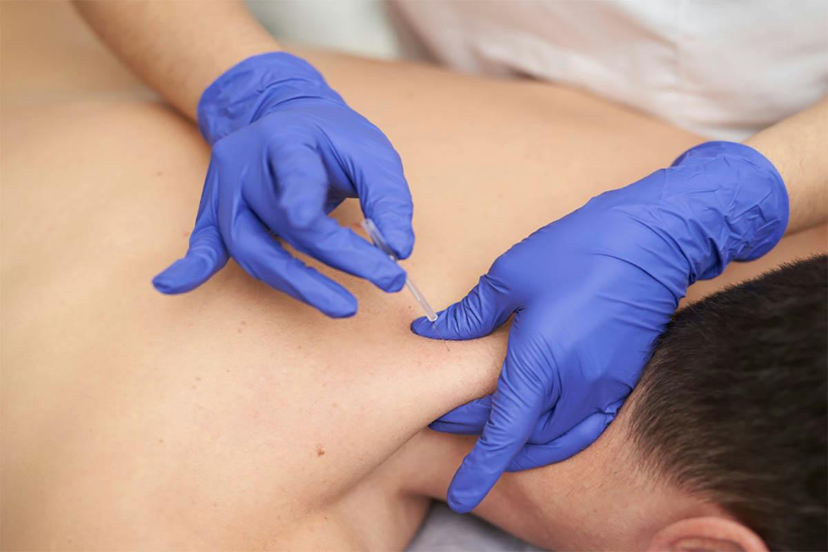 Does Dry Needling Hurt? Exploring Pain Levels and Benefits