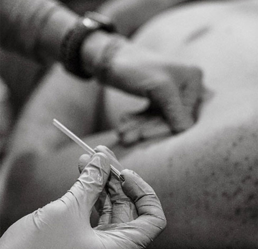 Black and white image of a close-up medical procedure. A gloved hand holds a small implant device or tool with a sharp tip, while another gloved hand is placing or removing an implant in the patient's arm at Progressive Mobility Physio & Performance. The patient’s skin shows visible pores and slight marks.